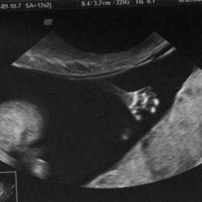 Bébé