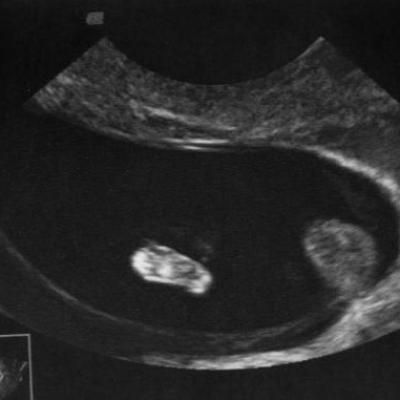 Bébé